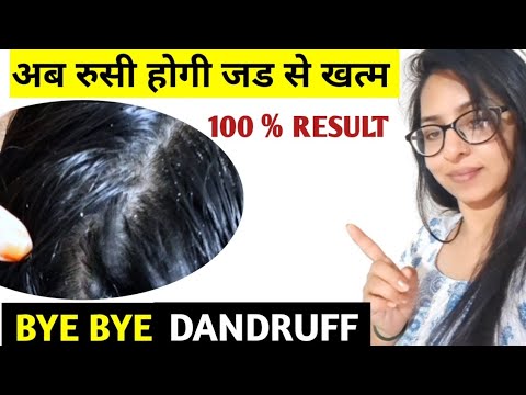 🔥#1 How to get rid of dandruff ll How to Treat Dandruff at Home | Hair Care Tips |