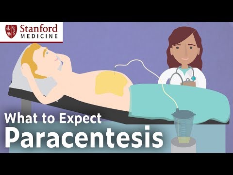 Paracentesis Procedure – What to Expect