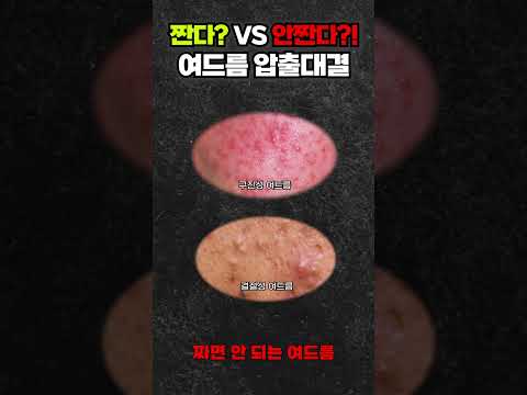 짠다? vs 안짠다?! 여드름 압출대결