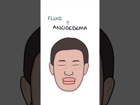 Causes of Angioedema #medicine #immunology #dermatology