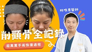 骨頭不用削！顴骨內推手術超真實記錄！｜凡登整形外科 林唯農醫師