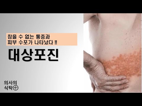 대상포진 : 참을수 없는 통증과 수포가 나타났다