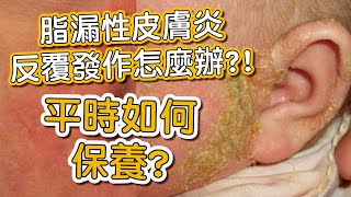 脂漏性皮膚炎好發在那些位置？一直反覆發作平時該如何保養？#shorts