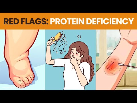 Protein Deficiency Symptoms - You Need to Know | 8 Signs of Low Protein