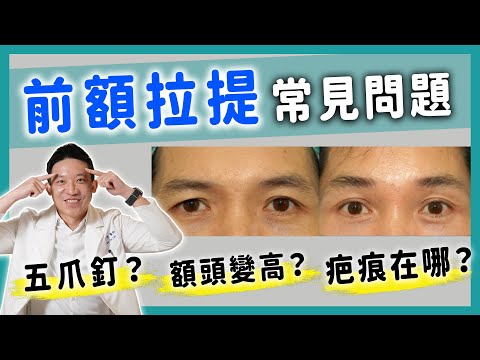 內視鏡額拉很痛嗎？提眉=額拉？可同時縫雙眼皮？會禿頭？眉壓眼就能做嗎｜新聖整形外科 林子宇醫師