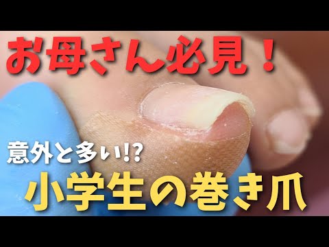 【意外と多い!?小学生の巻き爪】山形県寒河江巻き爪フットケアセンター　山形市・東根市・天童市からも多数来院中