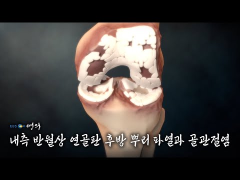 [명의 의학백과📖] 내측 반월상 연골판 후방 뿌리 파열과 골관절염