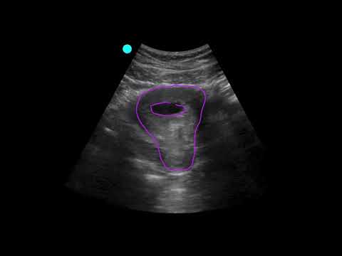 POCUS:  1st Trimester Pregnancy Case 2