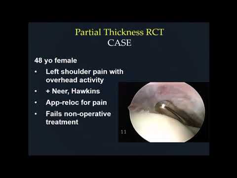 Presenter discusses partial rotator cuff tears, calcific tendinitis