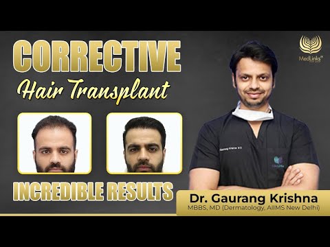 Incredible Results of Corrective Hair Transplants | Happy Patient Testimonial | MedLinks