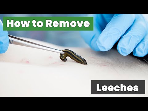 How to Remove Leeches: Quick and Easy!