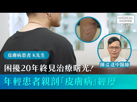 【病人故事】困擾20年終見治療曙光！年輕患者親剖「皮膚病」經歷