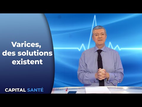 Varices, des solutions existent - Capital Santé