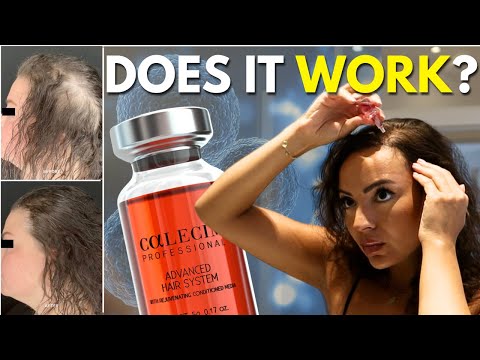 Hair Loss Cure That Could Change EVERYTHING! (Calecim Stem Cell Update)