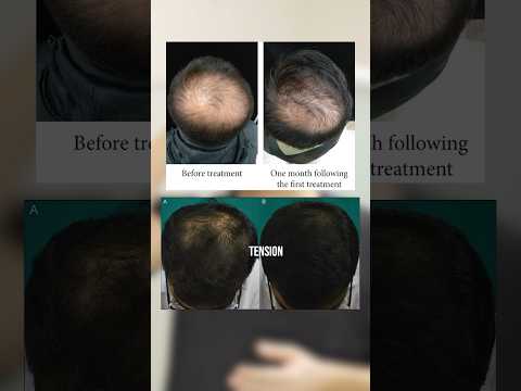 Accidental discovery for hair regrowth - Shocking!