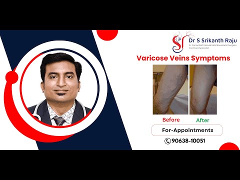 Varicose Veins Symptoms | Dr.Srikanth Raju | Vascular Surgeon | Hyderabad