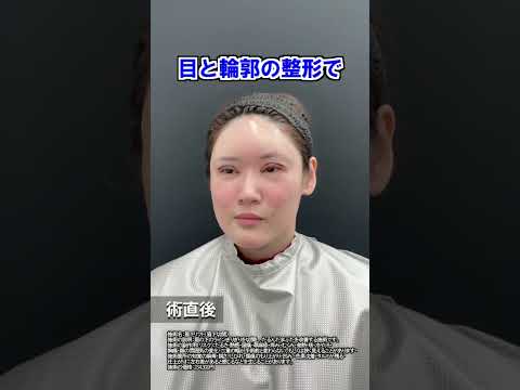 脂肪注入し放題＋目切開で20代女性が可愛く変身しました。