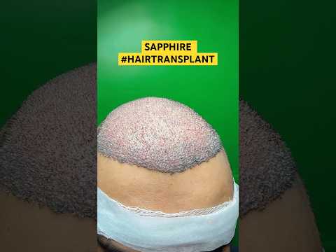 Hair Loss Treatment #hair #hairloss #hairlosstreatment #ytshorts #alopecia #hairtransplant #hairfall