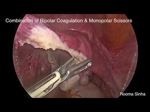 Laparoscopic Right salpingectomy for Ectopic Pregnancy Rooma Sinha Apollo Hospitals