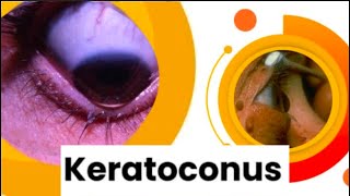 What is Keratoconus ?