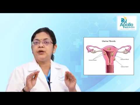 A Successful Uterine Fibroids Treatment on Mrs  Lakshmi Kala by ​​​​​​Dr  Rooma Sinha , Apollo Hyd