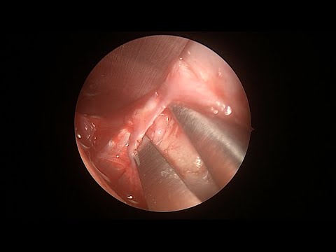 Neuromodulation of the lingual nerve: a novel technique