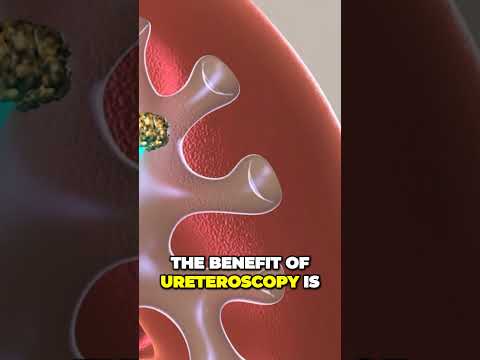 Ureteroscopy is a minimally invasive procedure to treat kidney stones and stones in the ureter.