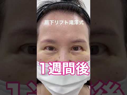 50代の眉下リフト、1週間後はどうなった⁉︎