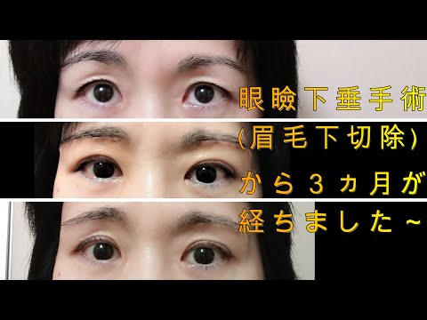 眼瞼下垂(眉毛下切除)手術から3ヵ月後