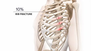 Management of Acute and Chronic Rib Fractures