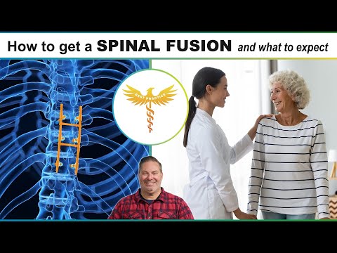 Spine surgeon explains: What to Expect with spine fusion, low back pain, spondylolisthesis, stenosis