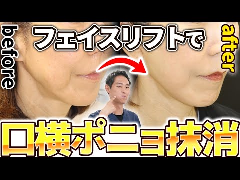 【たるみ治療】私のフェイスリフトは、口横のたるみを改善させる秘密があります！