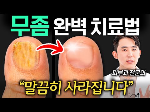 최고의 발 곰팡이 치료법, 무좀의 뿌리를 뽑습니다. (심현철 원장 3부)