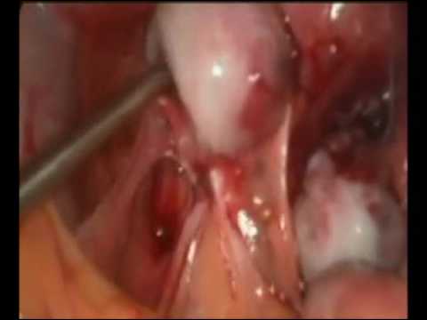 Laparoscopic endometriosis surgery 1   YouTube 360p