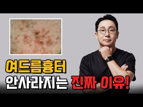 여드름 흉터, 왜 시간이 지나도 사라지지 않을까요? ⏱ │여드름흉터