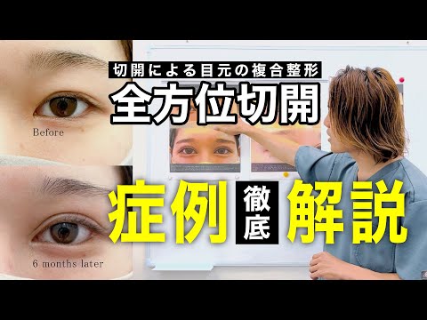 【全切開】人形のように目を大きくしたいお客様の全方位切開（360度切開）をご紹介！【Dr.木村竹男 執刀】