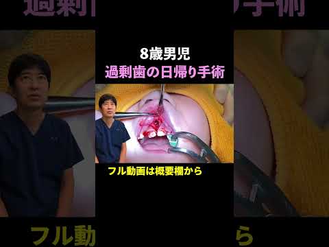 【過剰歯の抜歯】逆性の上顎正中過剰歯手術の手順・ポイントを解説 | ８歳男児 | 口腔外科専門医#shorts