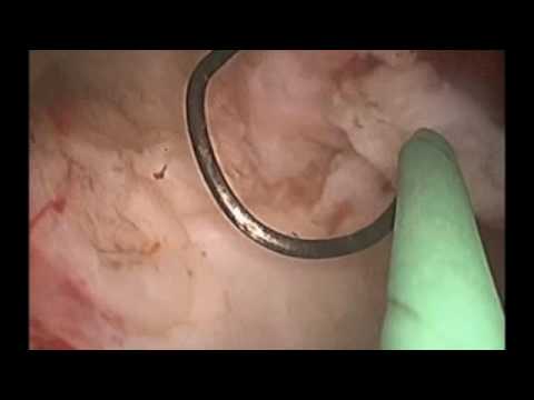 Myomectomy hysteroscopy  resectoscope