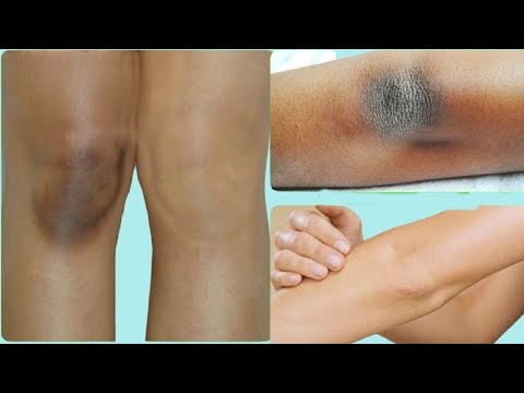 How to Get Rid of Dark Elbows | Home Remedies for Dark Elbows and Knees.