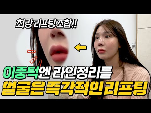 최강 리프팅 조합 ☺ 이중턱엔 라인정리 얼굴은 즉각적인 리프팅_ 모즈의원- 손승용