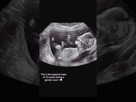 baby smiling during ultrasound scan at 15 Weeks #babyultrasound #pregnancy #babysmiling