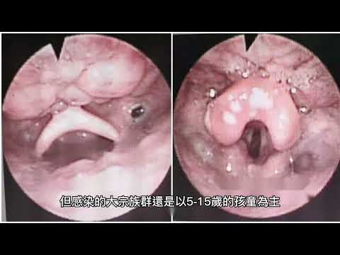 馬可--喉嚨劇痛、高燒不退，吃成藥都沒用，當心是a型鏈球菌感染!!