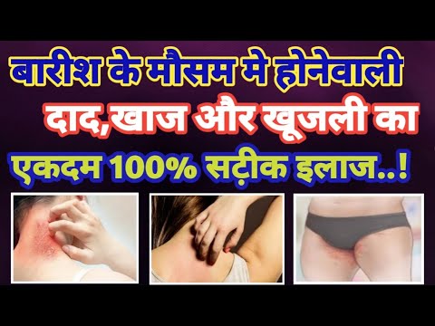 बारीश मे होनेवाली दाद,खाज,खूजली की समस्या का अचूक इलाज।Skin Diseases।lessonable thoughts।Health tips