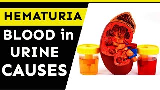 Hematuria: causes and evaluation of blood in your urine |  Nature Cure Fit