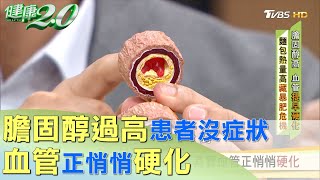 膽固醇過高患者沒症狀 其實血管正悄悄硬化 健康2.0