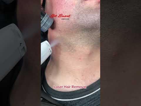 Laser Hair Removal #getsmarthairclub #viralvideo #hairremoval