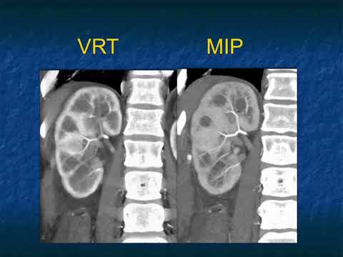 The Differential Diagnosis of Loss of Renal Corticomedullary Interface - Part 1