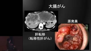 大腸がんの抗がん剤治療～いまとこれから～　山口 研成