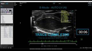 Auto LV vs LV Trace: B-Mode