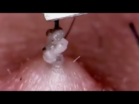 (7 Intense Blackhead Removal videos) | Poppy TV Ep#7 | viral video compilation